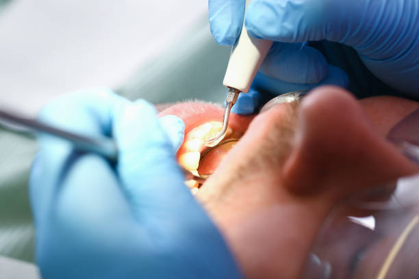 Best Emergency Treatment for Dental Infections or Abscesses in Montrose, NY