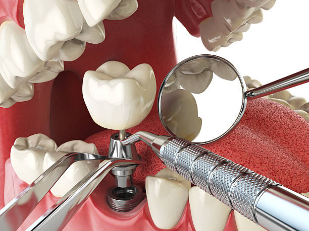 Best Emergency Treatment for Dental Infections or Abscesses in Montrose, NY